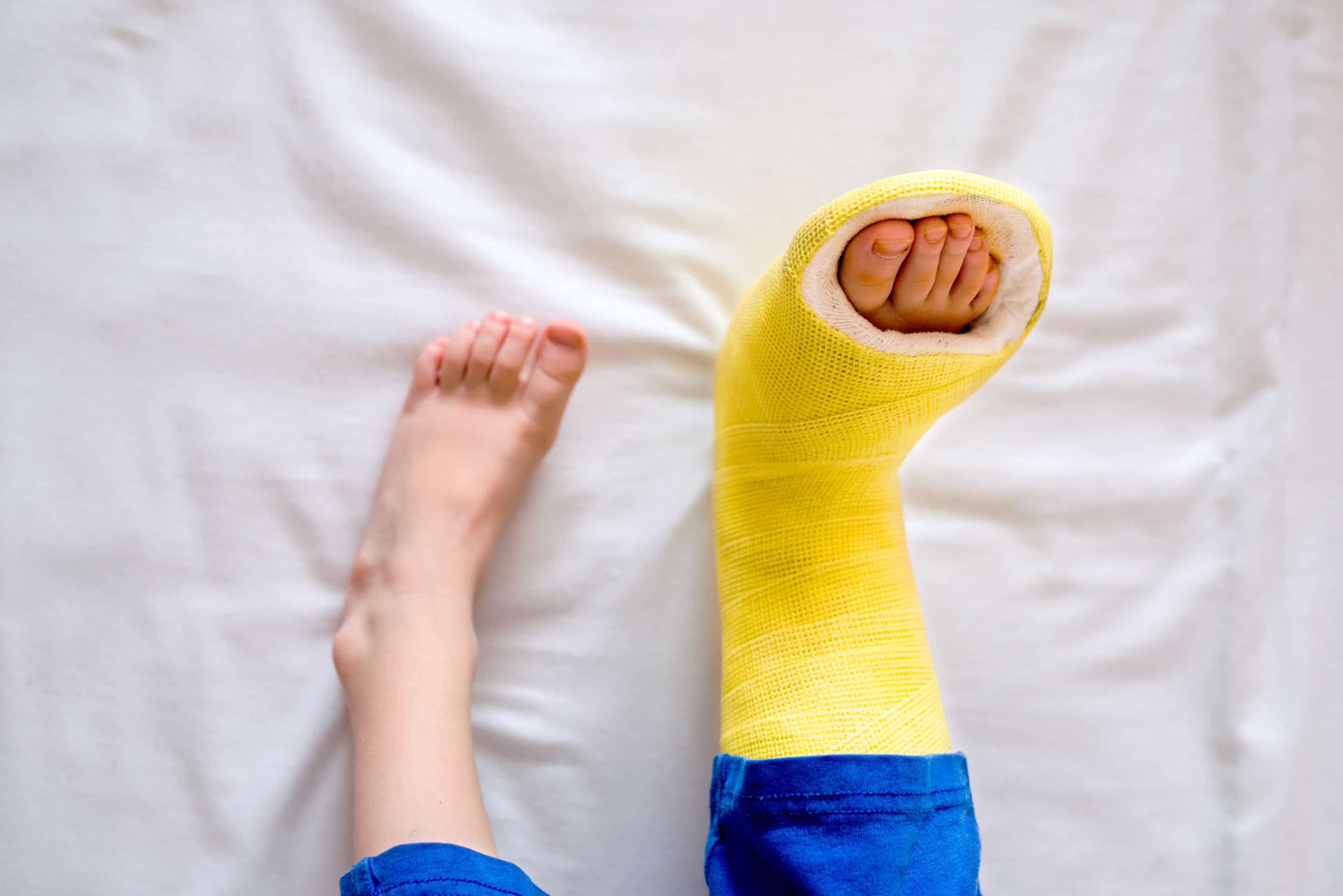 Broken leg in cast of unrecognizable little boy.